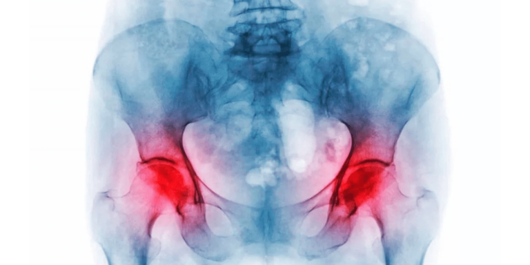 Leia mais sobre o artigo O que é Osteonecrose no quadril?