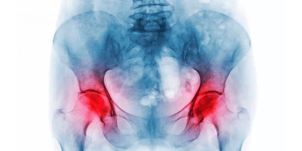 Você está visualizando atualmente O que é Osteonecrose no quadril?